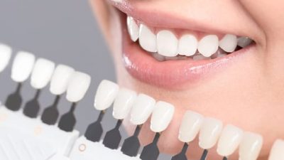 Inilah Cara Memutihkan Gigi Perokok, Yuk Dicoba