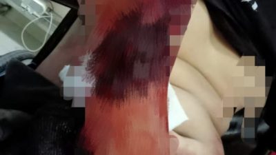 Ngeri, Lengan Pemuda ini Nyaris Putus Akibat Aksi Tawuran di Ciomas