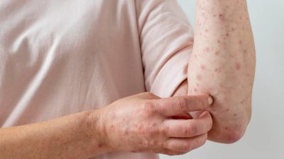 Cegah Kasus Mpox, Pemerintah Tingkatkan Kewaspadaan di Bandara Soetta